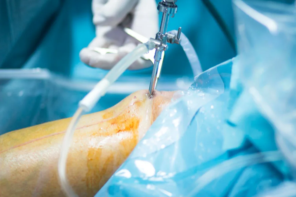 Artroscopia de hombro en Nuevo Leon