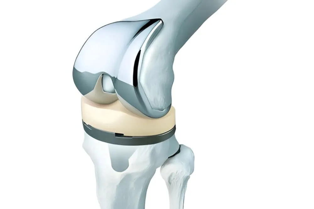 Prótesis de rodilla